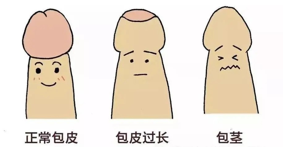 包皮过长，危害多多！不止脏脏，还影响啪啪