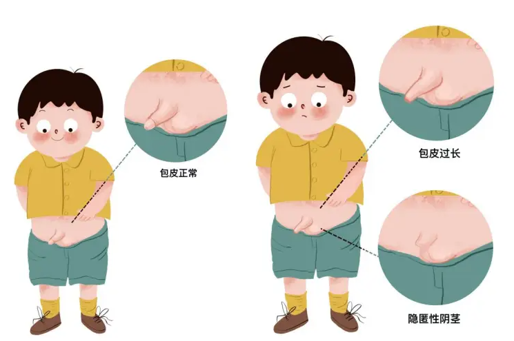 包皮健康自查手册：男性健康的隐秘防线